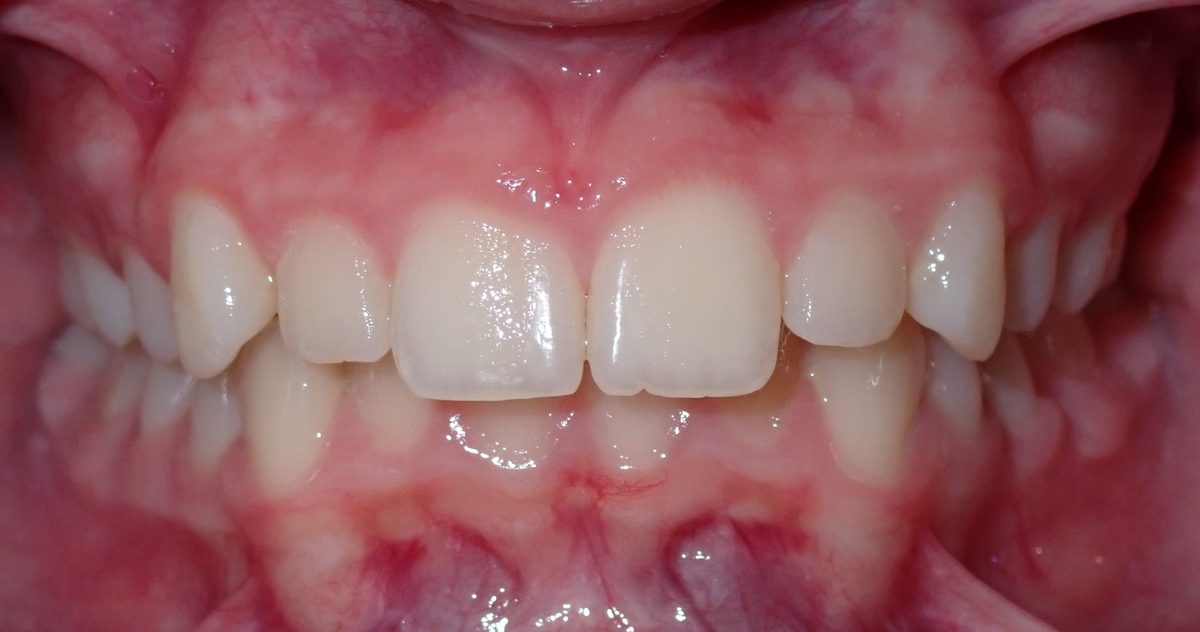 Vivid Smiles patient case 4 before and after treatment comparison before
